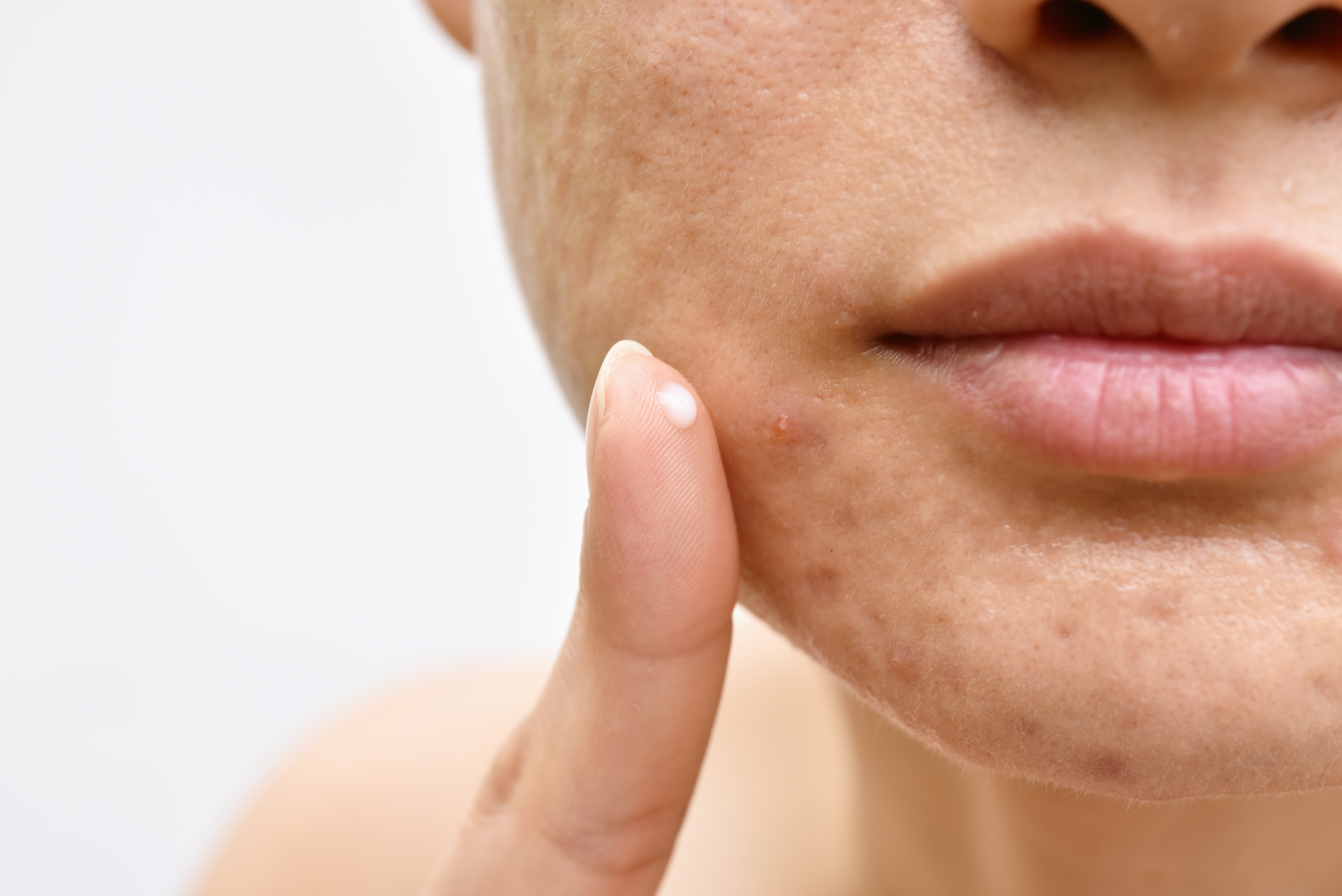 siero acne